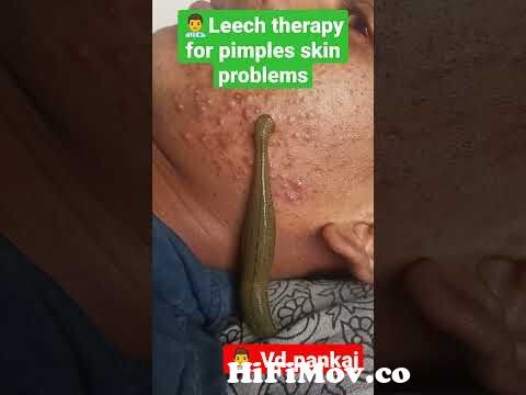 leech therapy for skin problems #pimples #ayurveda #skinproblems #shorts #panchkarma #hairfall #mp from ls junior nude sex modellooja boobs Watch Video - MyPornVid.fun