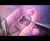Ear Cleaning