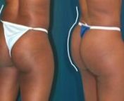 What happens if you lose weight after having a brazilian butt lift?Will you lose your new enhanced buttocks?The answer is. . . if the fat injection procedure is done properly--it sticks no matter how your weight fluctuates!nYour new augmented buttocks will remain with you even if you lose weight. Dr. Rodriguez, a Yale trained Plastic Surgeon explains why.nnTo see Before and After Brazilian Butt Lifts, visit our photo gallery page: http://www.cosmeticsurg.net/procedures/brazilian-butt-lift/be
