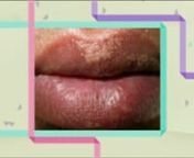 Visit our site http://fordycespotsguide.com for more information on fordyce spots.Fordyce Spots are found on the shaft penis, scrotum, labia, or outer border of the lips. They appear either as a single or a group of lesions. The spots&#39; characteristics and location make them easy to be mistaken for other form of skin lesions. When found on the penis, they are wrongly thought of as pearly penile papules.