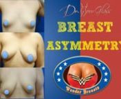 One of the most frustrating part of being a plastic surgeon is getting women to understand that their breasts are sisters, not twins. What do I mean by this? Whenever you have a breast augmentation, you need to understand that prior to surgery, 100% of women on earth have some sort of asymmetry in their breasts, and this is absolutely normal. It is not that I am criticizing; it is just the way it is, the way God makes everybody. Every part of the body is asymmetric. Asymmetries can come in many