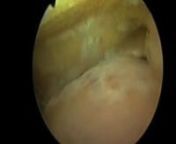 http://www.ankle-arthroscopy.co.uk/nnArthroscopic Ankle ArthrodesisnnNew and improved video with voice-overs from Consultant Orthopedic surgeons Mr. Simon Moyes and Mr. Omar Haddo